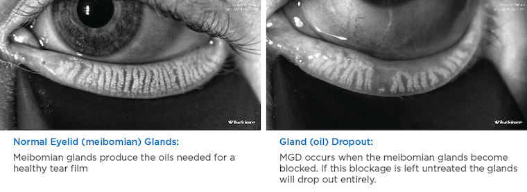 LipiScan Analysis of MGD