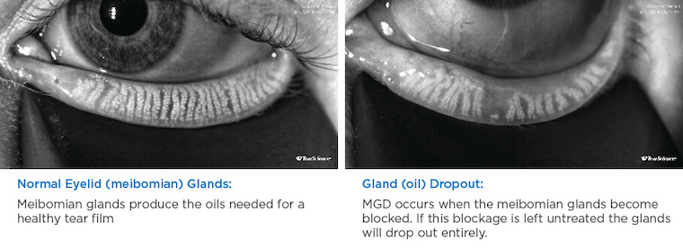 Normal eyelid glands vs. gland dropout comparison photo