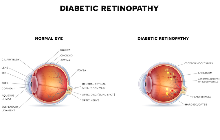 Diabetic retinopathy comparison chart