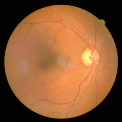 Image of an eye ball with diabetic retinopathy