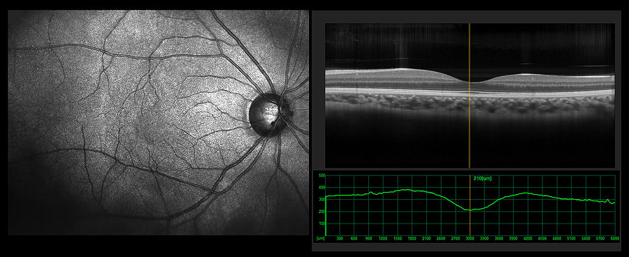 Ophthalmic Test (OCT) image